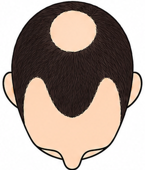 Stage 4